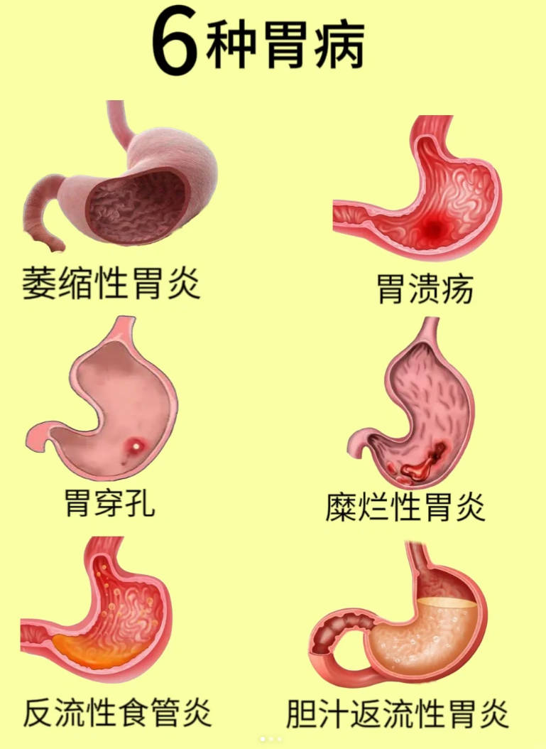 常见的6种胃病!你有这些症状吗?